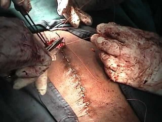 Obstetrics and Gynaecology - Total Abdominal Hysterectomy Closure of the abdomen
