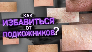 Подкожники. Что такое и как от них избавиться