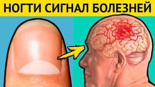 НОГТИ - предвестники СТРАШНЫХ БОЛЕЗНЕЙ. Диагностика болезней по ногтям