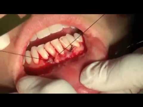 Gum Graft Surgery Periodontal Tunneling