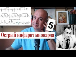Инфаркт миокарда - 5. Аритмии и блокады