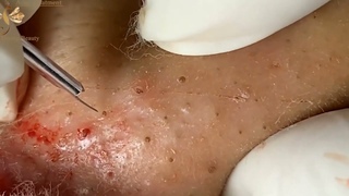 Black heads Extreme, Blackhead Extraction Frenzy: Satisfying Pimple Popping Video