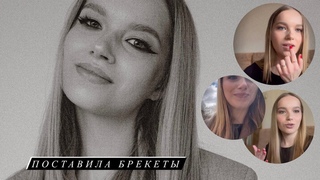 ПОСТАВИЛА БРЕКЕТЫ // РЕЗУЛЬТАТЫ ЗА 2 МЕСЯЦА, СТОИМОСТЬ, ВПЕЧАТЛЕНИЯ