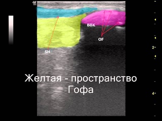 Болезнь Осгуда Шляттера