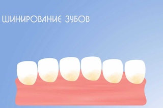 Что такое шинирование зубов? Для чего оно необходимо?