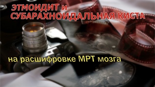 СУБАРАХНОИДАЛЬНАЯ киста, ЭТМОИДИТ и КИСТА в правой пазухе носа на РАСШИФРОВКЕ МРТ головного мозга