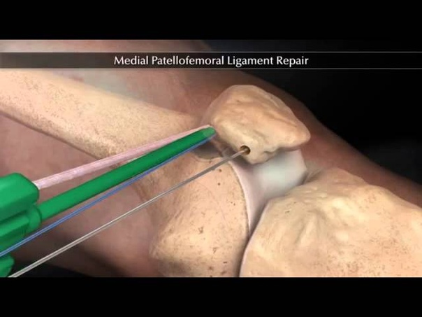 Пластика пателло феморальной связки ( Medial Patellofemoral Ligament