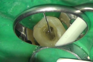 Endodontic  percha retreatment